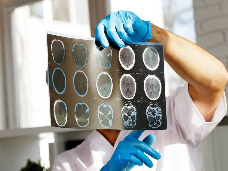 What Can a NeuroQuant Brain MRI Detect?