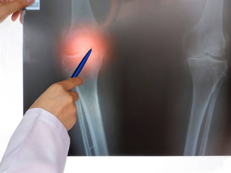 What Are the Benefits of an Arthrogram?