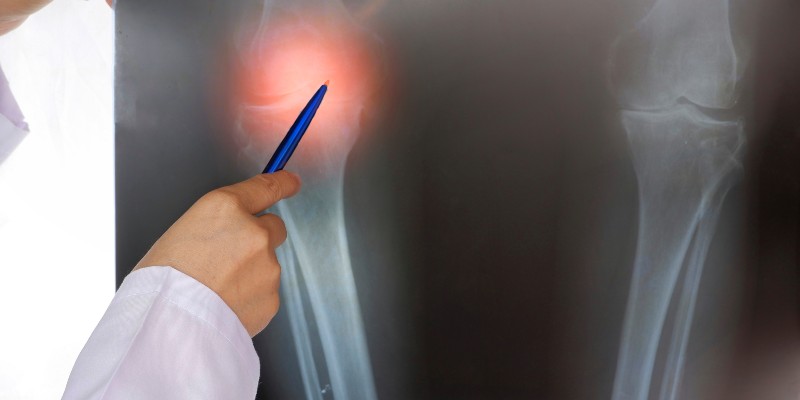 How Long Does it Take to Recover From an Arthrogram?