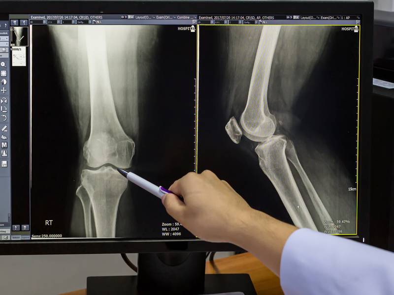 What Is an Arthrogram?